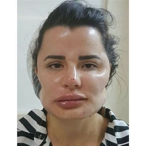 brazilian women plastic surgery